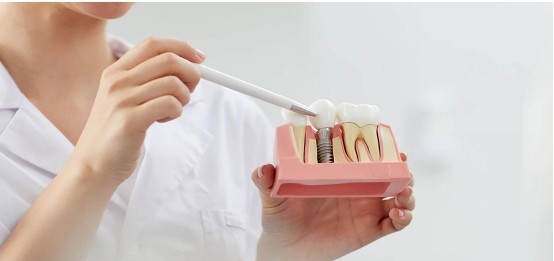 Cabinet dentaire Claude Monnet implantologie