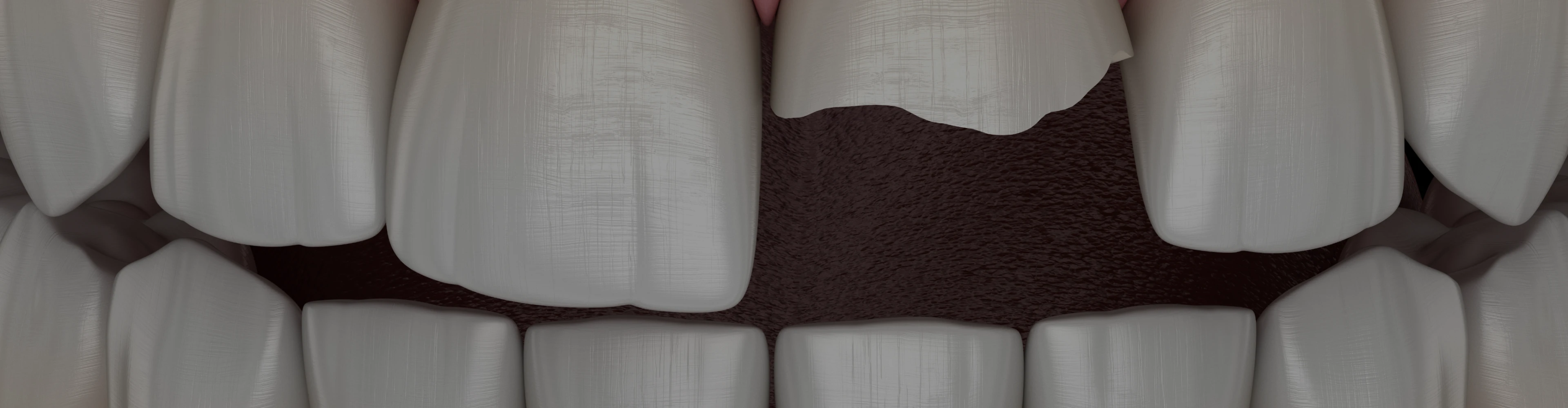 dent-fracturee-conseils-dentiste-croissy