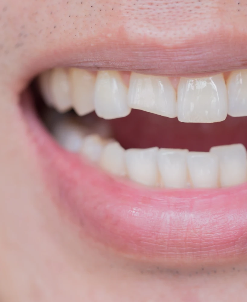 dent fracturee dentiste croissy