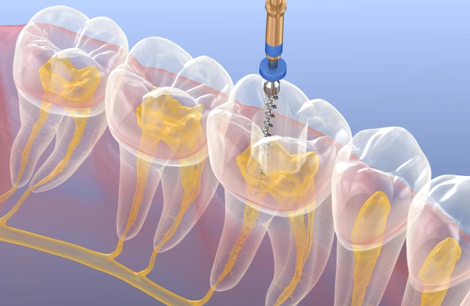 Dévitalisation dentaire au cabinet Dentaire Claude Monet à Croissy-sur-Seine