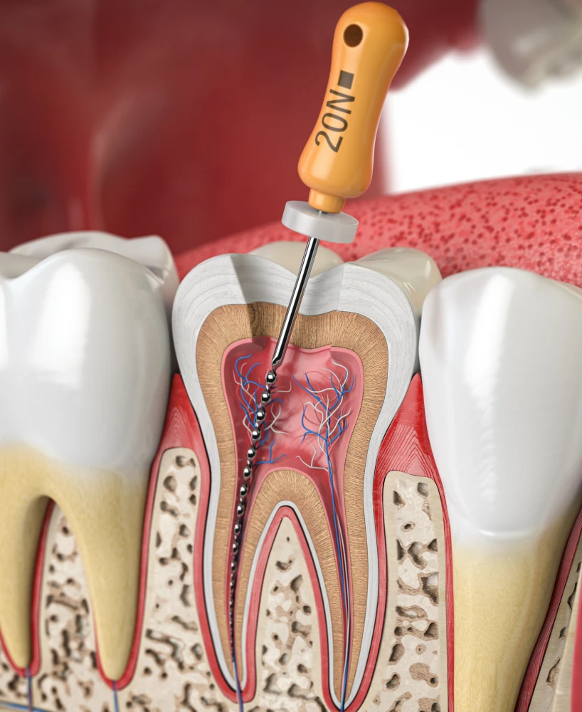 traitements endodontique dentiste croissy