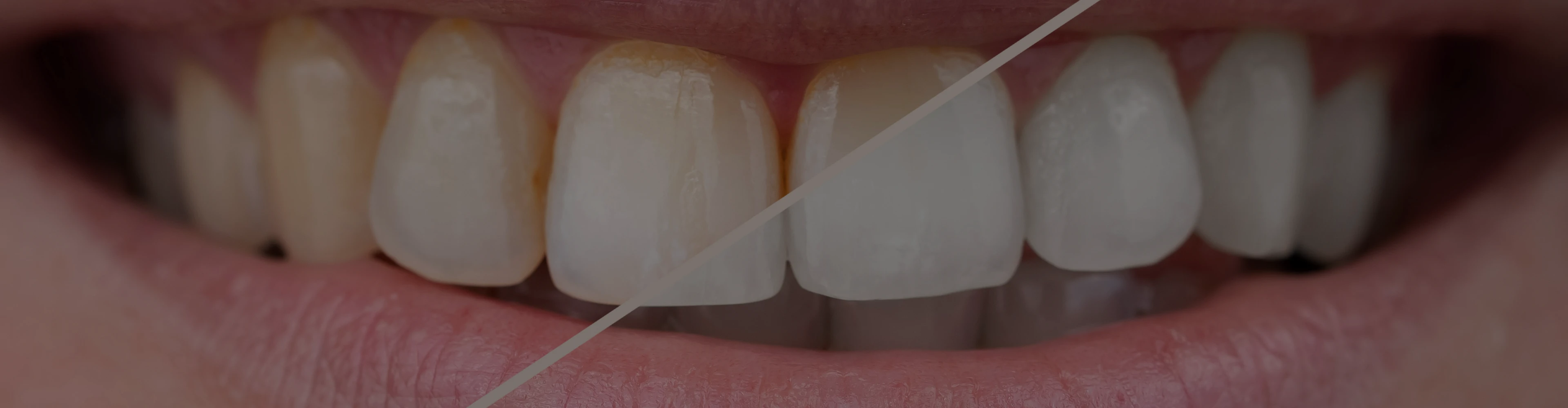 combattre-dents-jaunes-dentiste-croissy