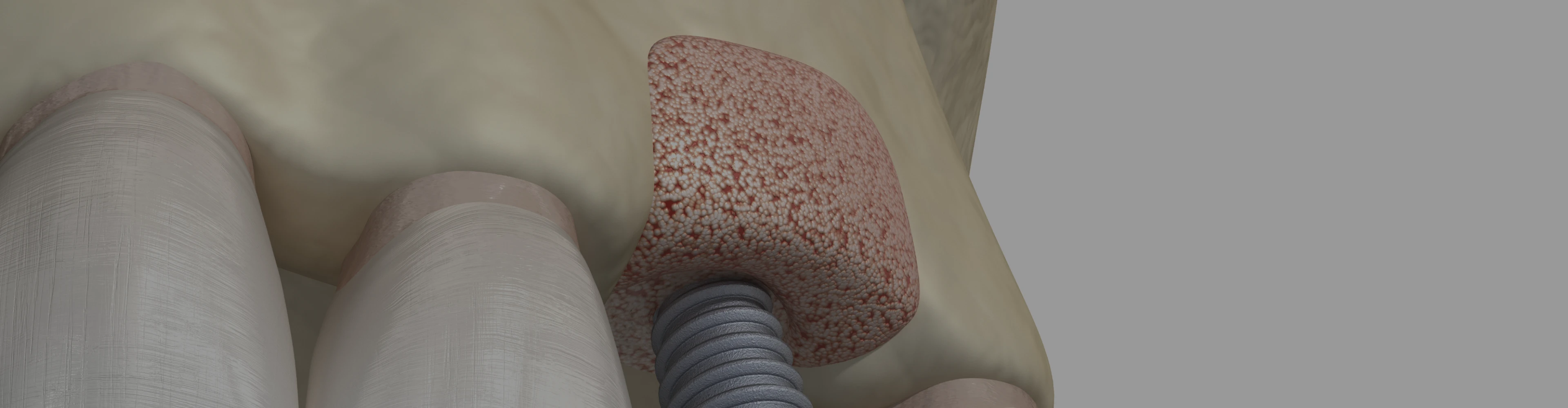 greffe-osseuse-dentiste-versailles