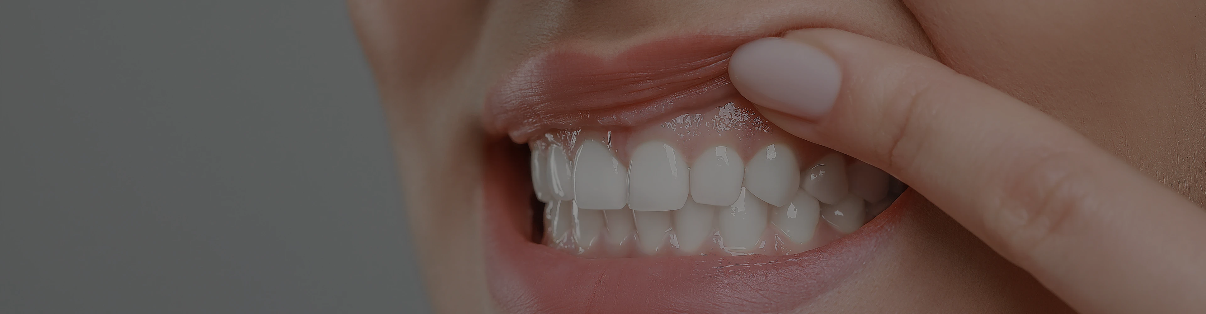 remodelage-gencives-versailles