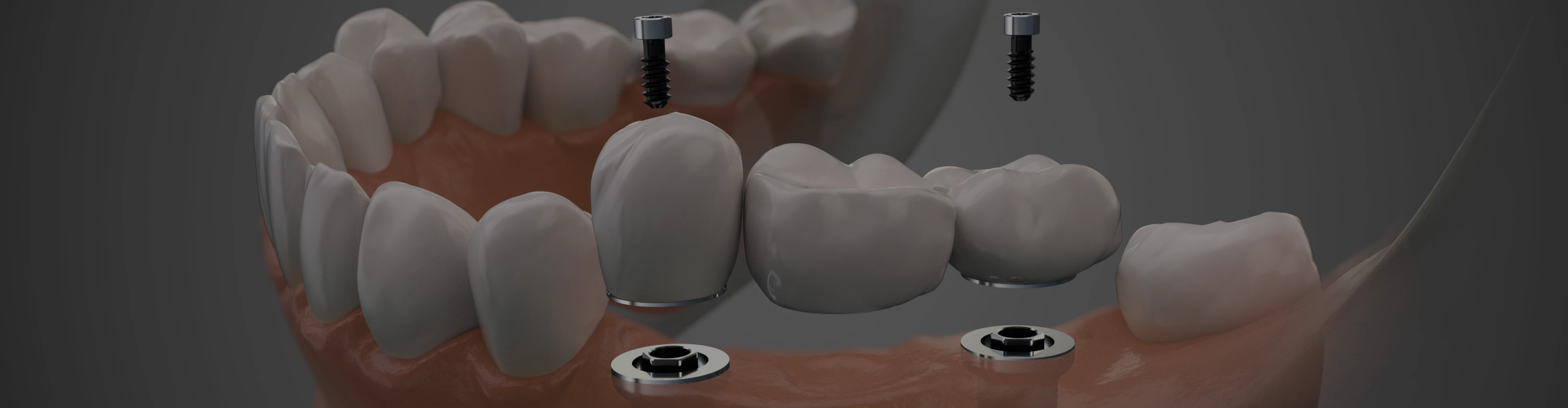 implantologie-chirurgie-orale-dentiste-croissy-sur-seine