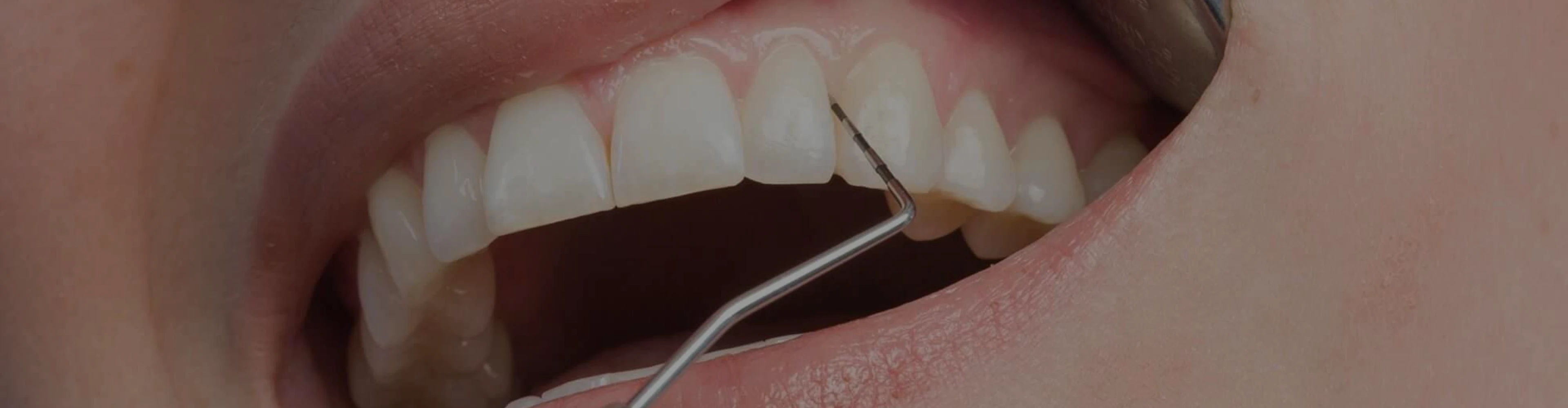 maladies-parodontales-dentiste-croissy