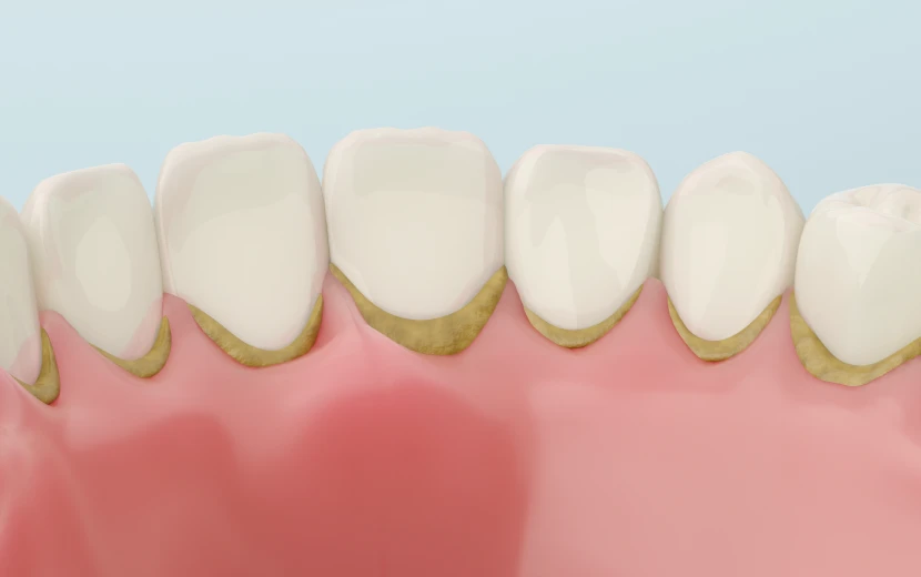 Traitement des maladies parodontales