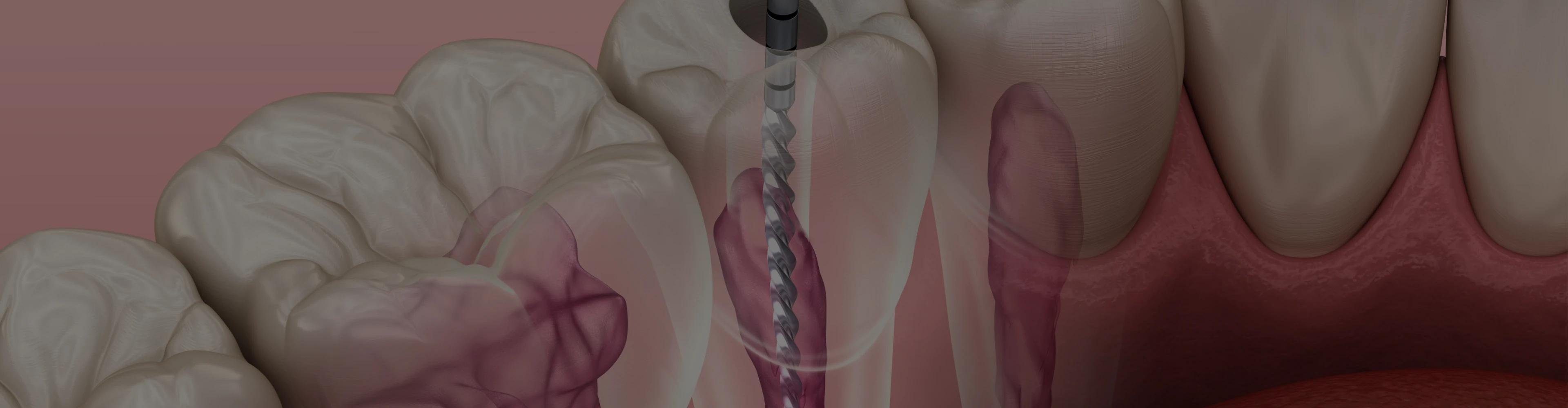 soins-endodontie-dentiste-nguyen-van-duong