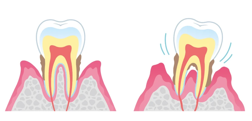 Traitement des maladies parodontales