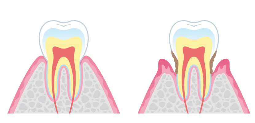 Traitement des maladies parodontales